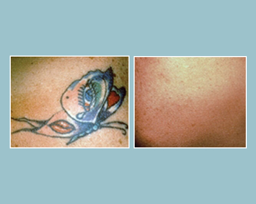 Before & After Laser Tattoo Removal
