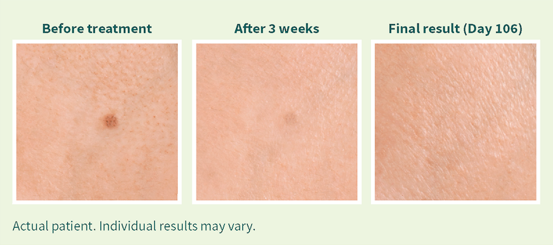 Seborrheic Keratoses Treatment Exceptional Dermatology Care 9607