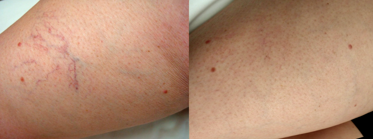 Before & After Sclerotherapy
