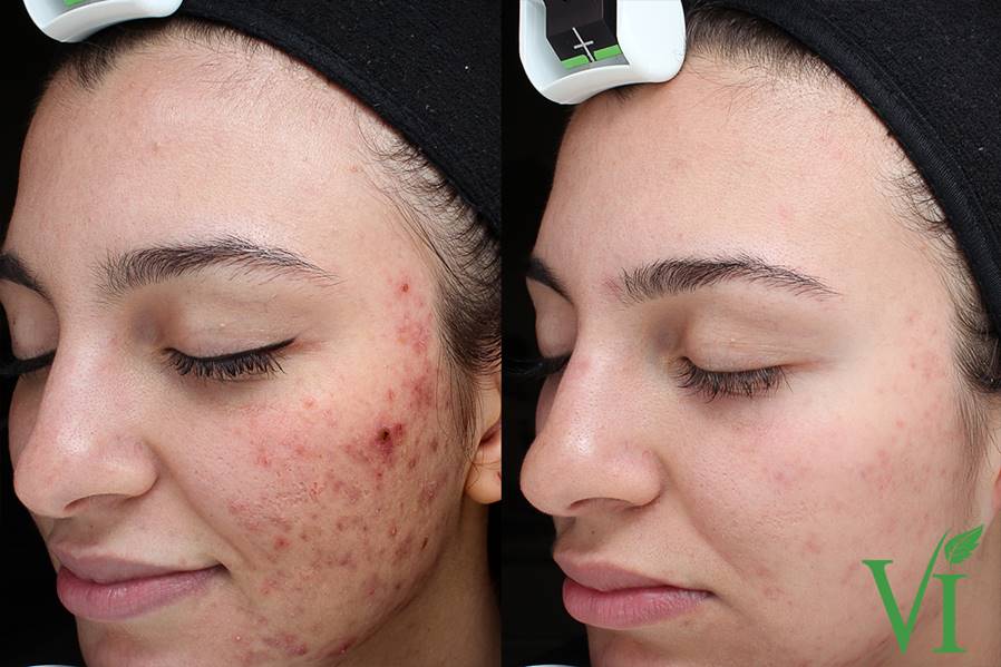 Before & After Vi Peel