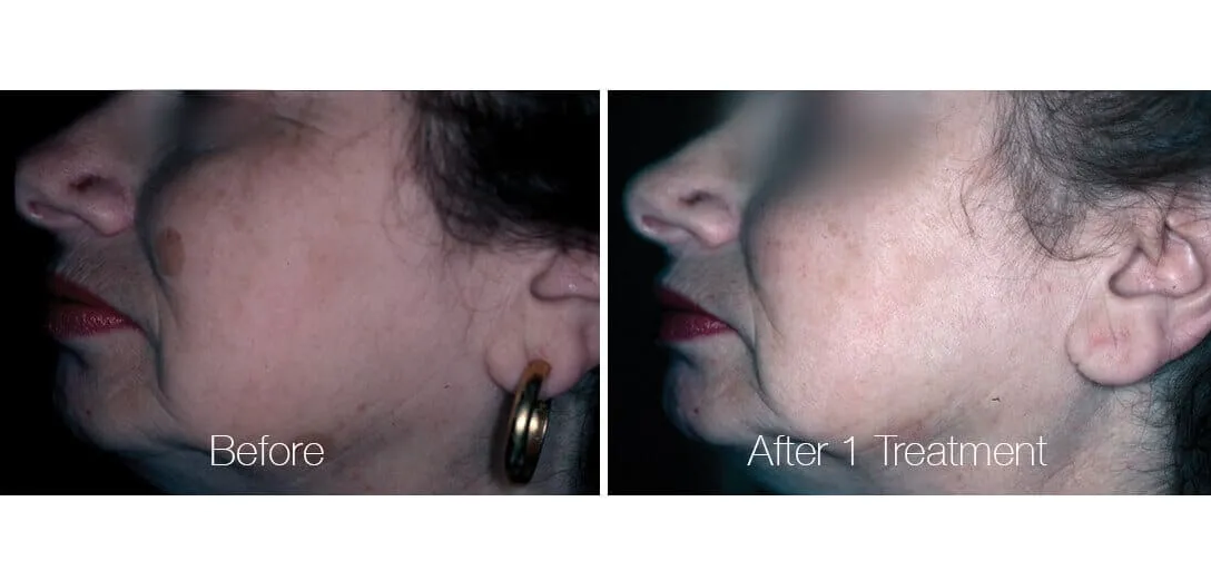 Before & After Pigmentation Laser Treatment