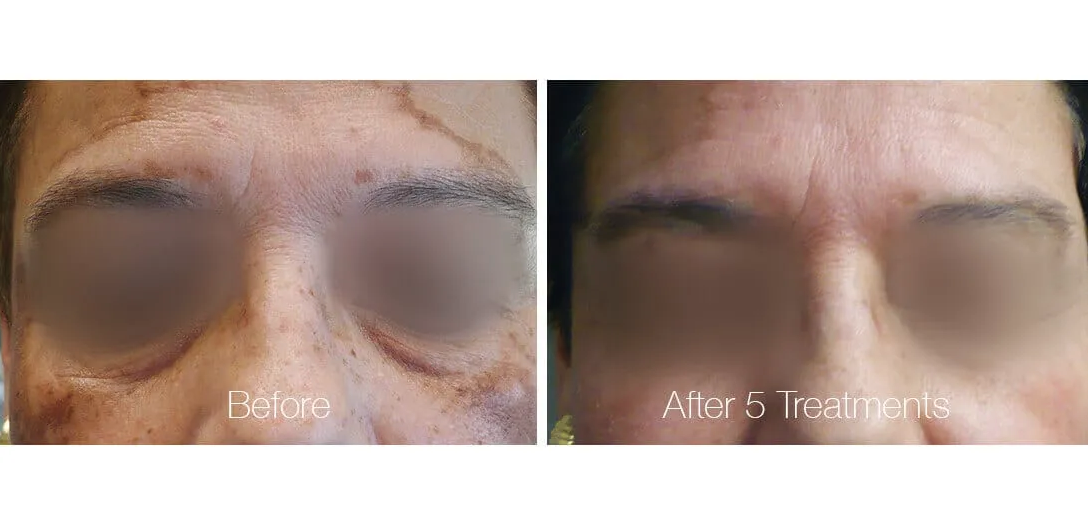 Pigmenation Laser Treatment Exceptional Dermatology Care Fullerton, CA