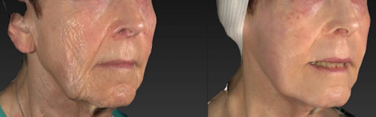 X|Rated Exosome Facial - Exceptional Dermatology Care