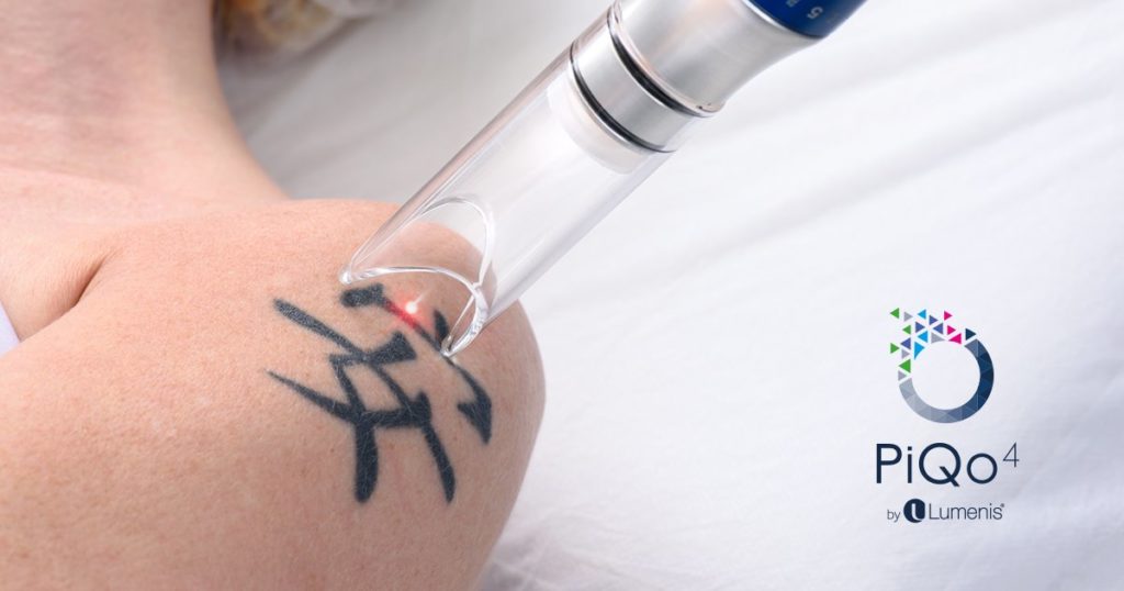 Tattoo Removal Exceptional Dermatology Care Fullerton, CA