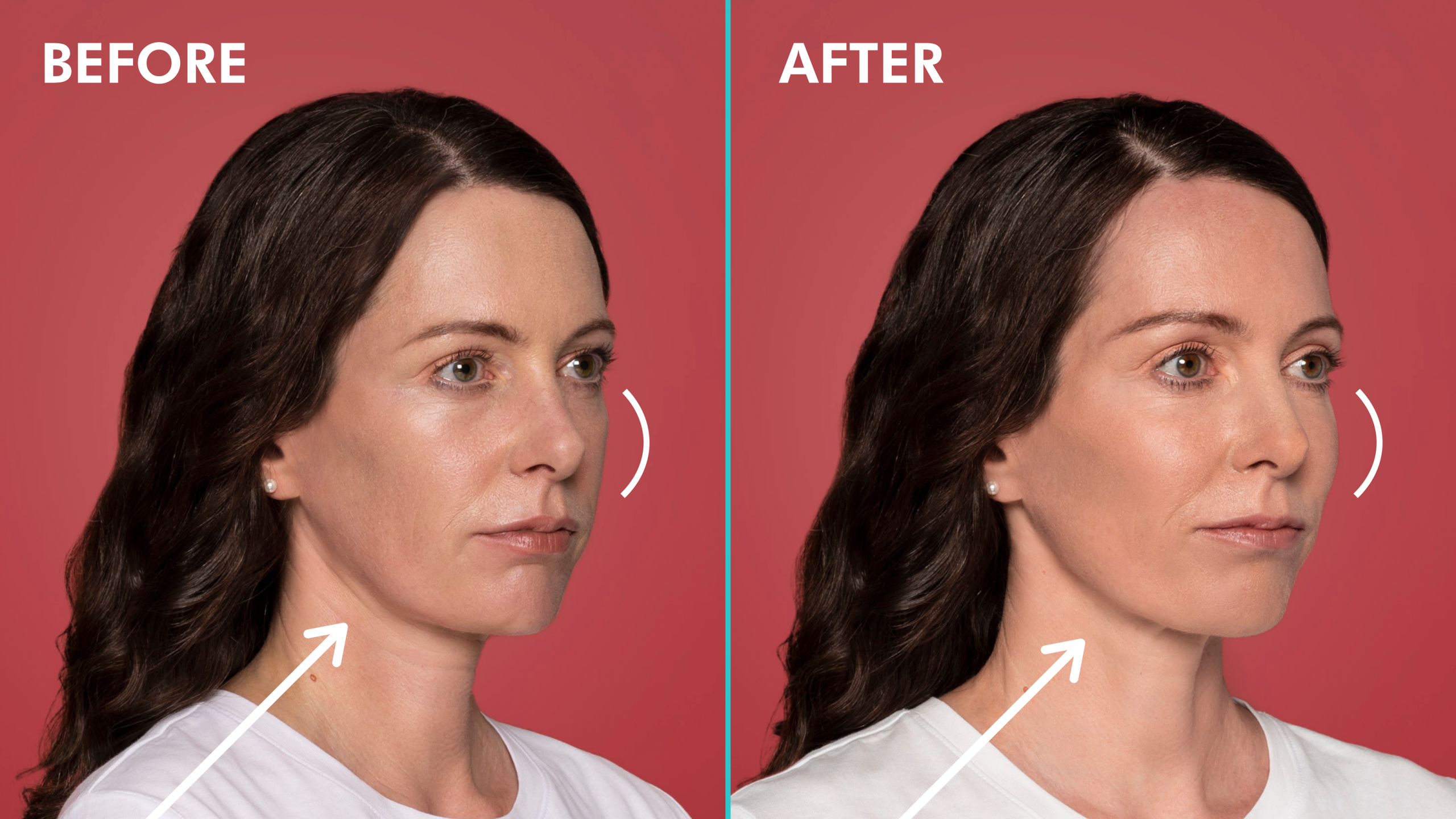 Before & After Restylane Contour