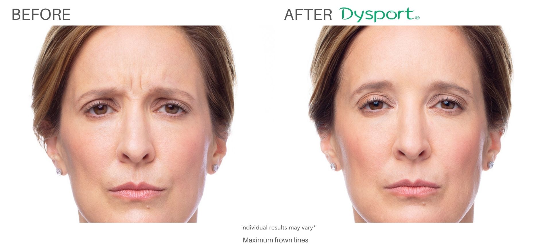 Before & After Dysport