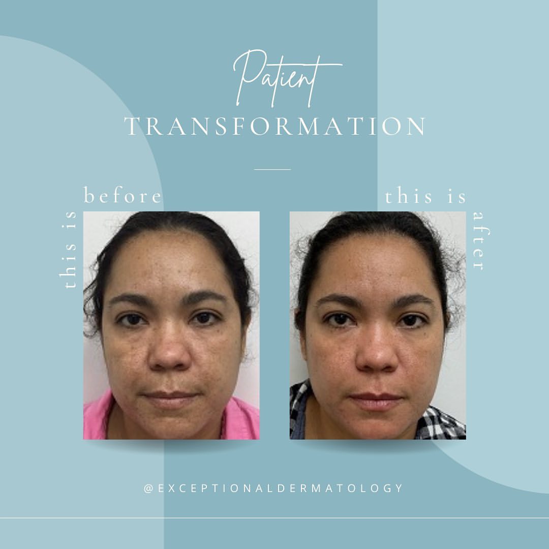 Before & After HydraFacial