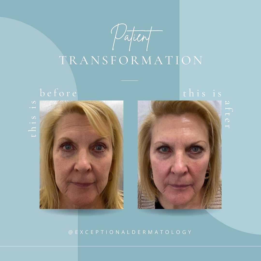 Before & After Sculptra