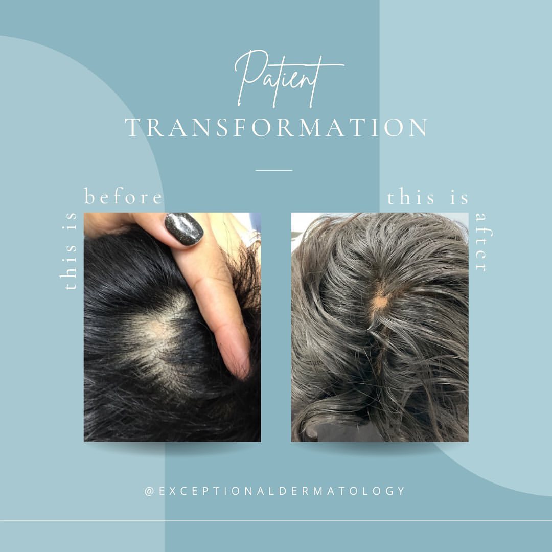 Before & After Hair Loss Treatment